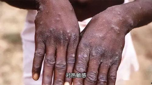 猴子爆料皮肤真假辨别视频,教你轻松辨别皮肤真假  第1张